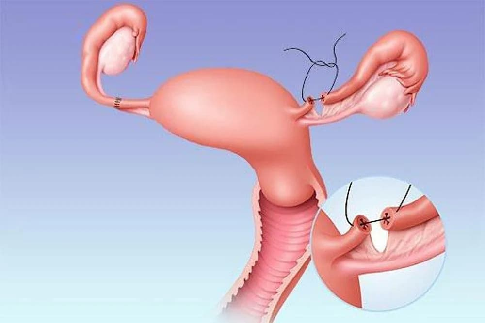 Беременность после перевязки маточных труб