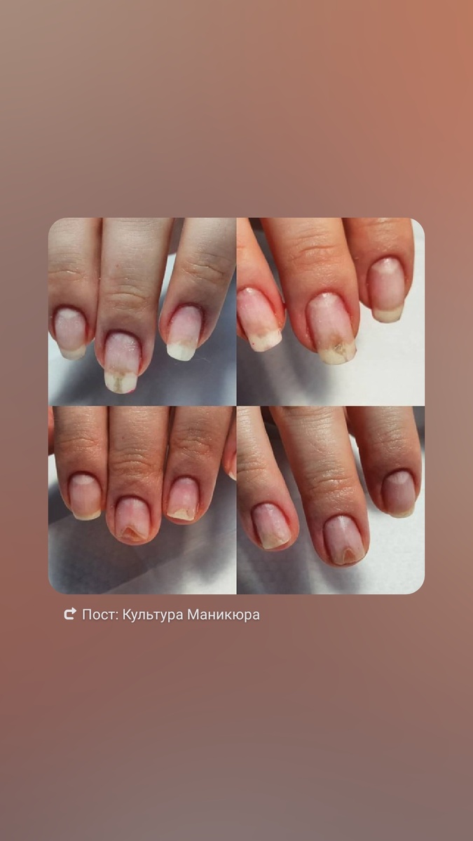 Но вот в чем сложность. Клиентам хочется ногти подлиннее, и подольше походить с ними. Но, увы, «Shellac» наносился тонким слоем и «не держал длину». К тому же, на тонких ногтях он иногда плохо держался, требовалось укрепление акрилом или гелем.

И вот тут все началось. Выравнивание базой, хотя изначально, как я уже сказала, у базы была несколько иная задача. Ну и производители молодцы, подсуетились. Нужна база для выравнивания – получите. Главное, удовлетворить спрос и предложить что-то новенькое. Конечно, я не против прогресса и считаю, что нейл-рынок должен развиваться. Чего стоят только наши любимые полигели, наши палочки-выручалочки! Но очевидно же, что базы с новыми свойствами имеют и другой химический состав. И это, несомненно, ведет к каким-либо особенностям в работе. К чему я веду? Например, толщина базового слоя. Уже сто раз об этом говорили, но нет… То там, то здесь слышу: «Ерунда все это! Разными базами так делала, все хорошо было!». Но об этом чуть позже.

Что мы имеем в итоге? 