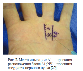 Мкб 10 лигаментит кисти. Мкб 10 лигаментит кисти. Мкб 10 лигаментит кисти. Лигаментит синдром нотта. Контрактура дюпюитрена операция.