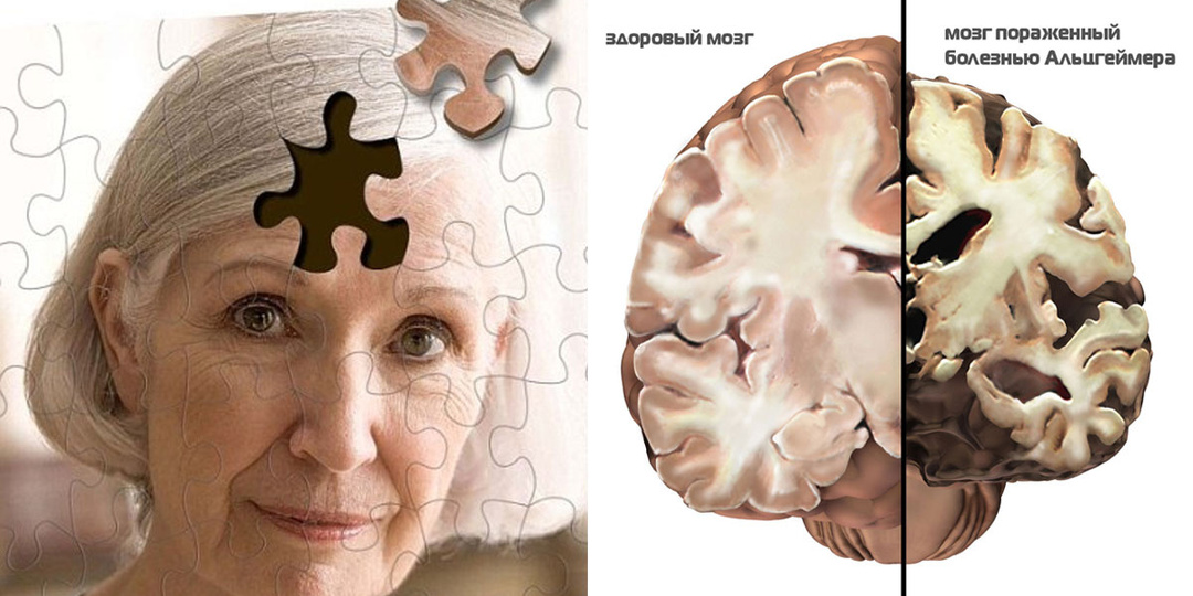 Профилактика болезни Альцгеймера: как сохранить ясность ума на долгие годы