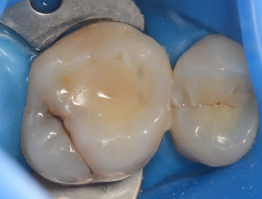 "Плоская" пломба без живательных бугров 