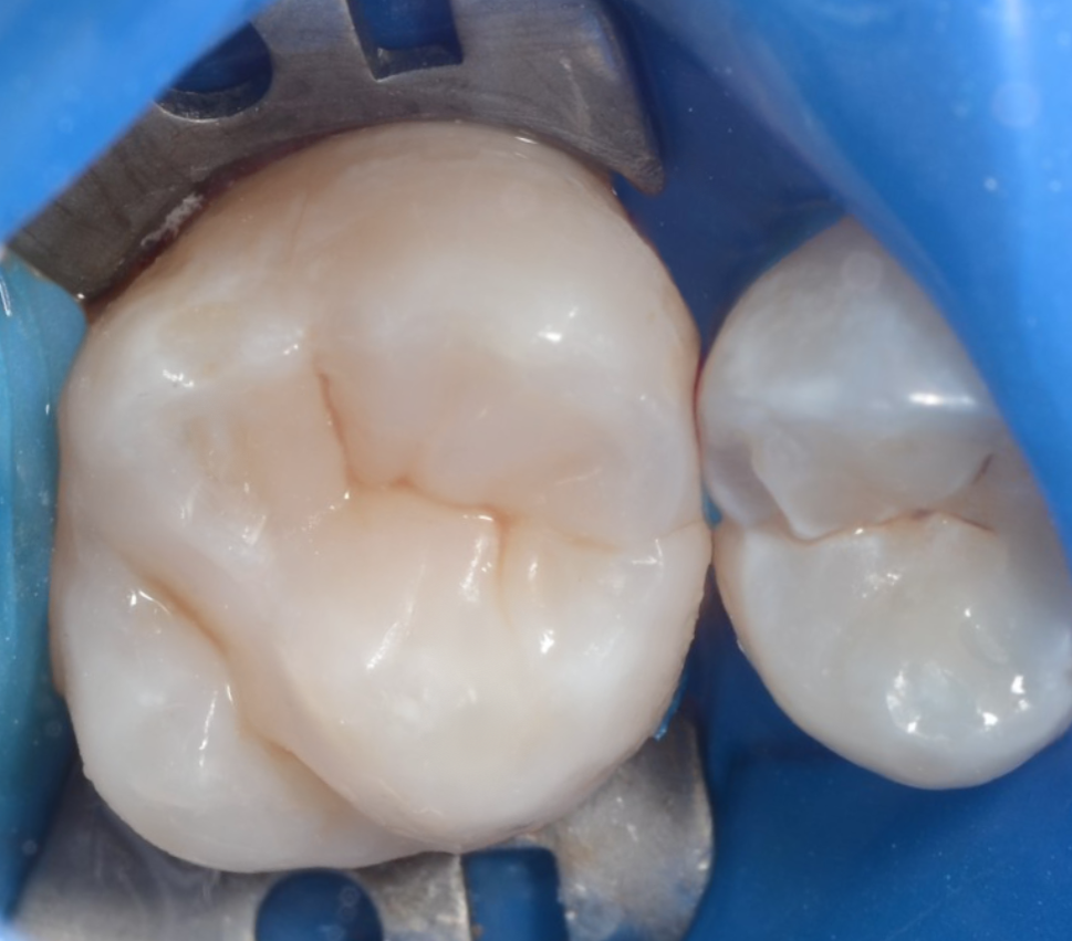 Зуб с восстановленной жевательной анатомией