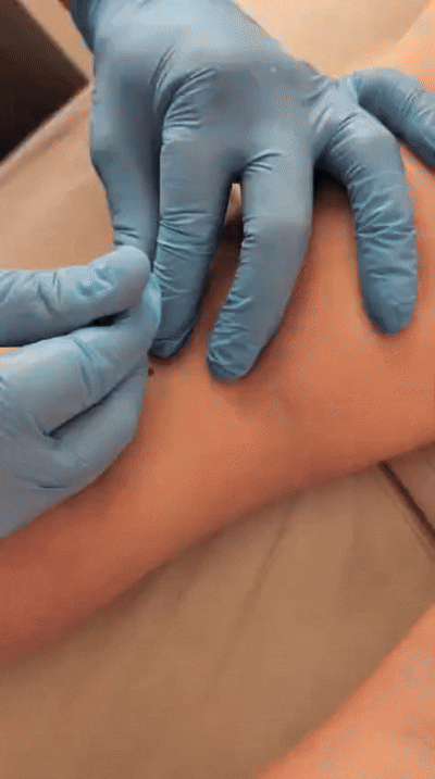 Чтобы уплотнения быстрее рассасывались, через 2 недели в плотных местах мы делаем прокол иглой от шприца и выпускаем оттуда скопившуюся коагулу (кровь смешанная со слкерозантом). Процедура не очень приятная, но зато после нее все быстро проходт.