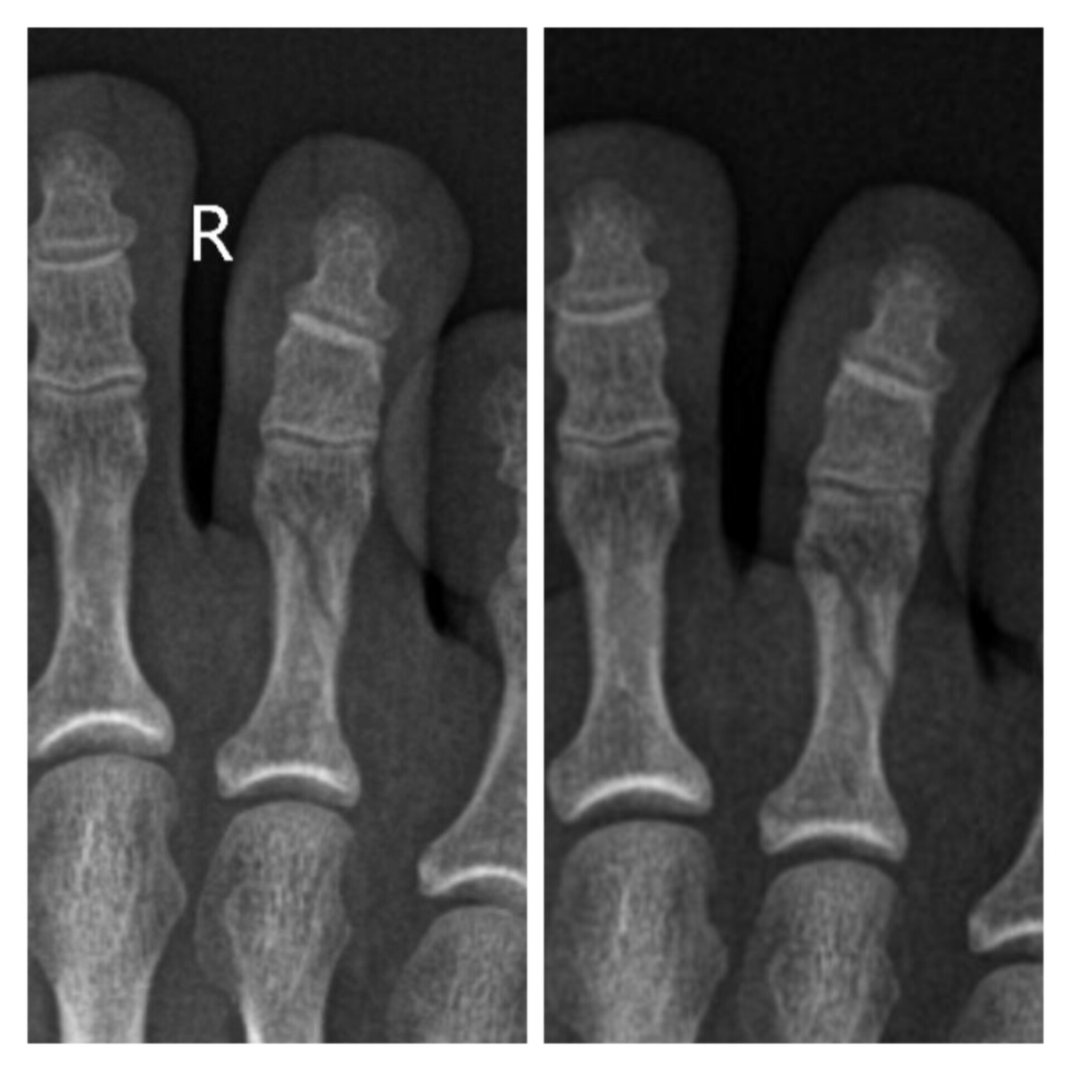Вот так выглядит полный косой перелом пальца