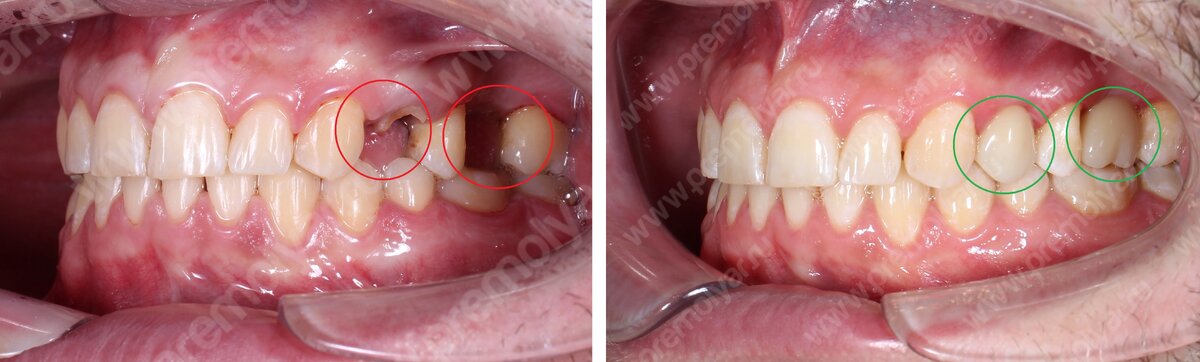 Слева отсутствуют 2 зуба, справа установлены 2 временные коронки из полимера на месте отсутствующих зубов.