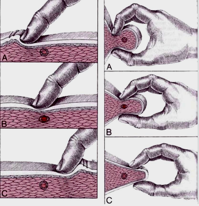 Ишемическая компрессия триггеров 