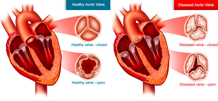  Аортальный стеноз 