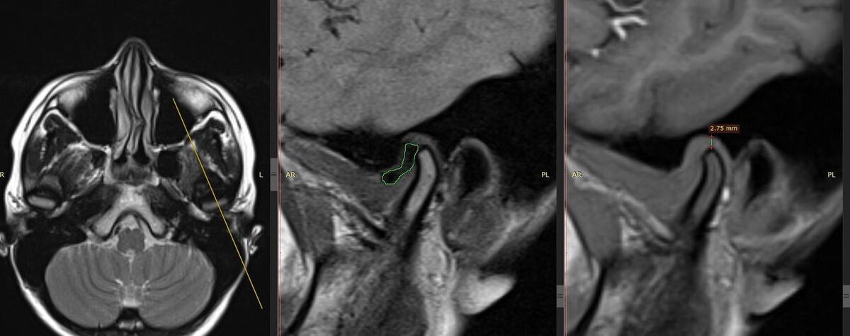 фото 1 - дистальное смещение суставной головки и неполная вентральная дислокация суставного диска с репозицией