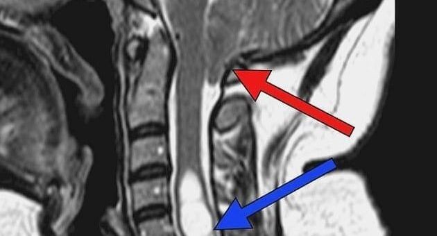    МРТ: красная стрелка показывает опущение миндаликов мозжечка ниже большого затылочного отверстия / Пресс-служба Долгопрудненской больницы