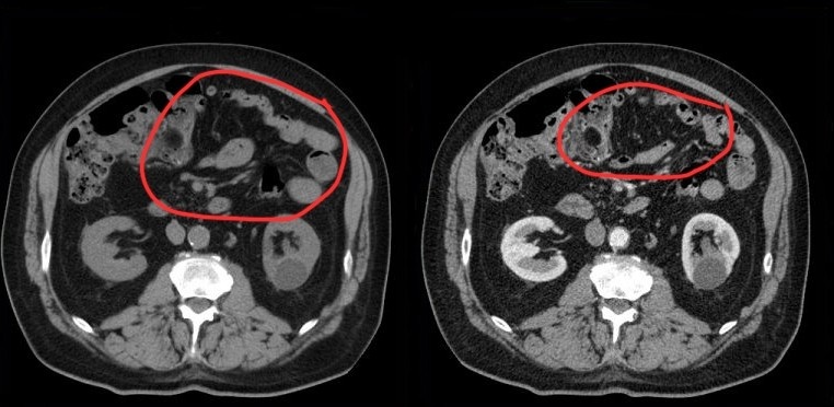 Аксиальные срезы в нативную и артериальную фазы исследования. Плотность брыжейки не отличается от плотности жира иной локализации. Киста нижней трети левой почки, Bosniak I 