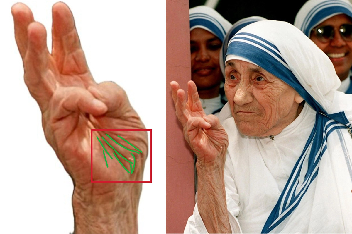 Руки «Матери Терезы». Возраст 87 лет. Линии судьбы, жизни, Марса (Ангела-хранителя) очень четко видны в «квадрате старости». Фото взято из интернета. Прорисовка автора.