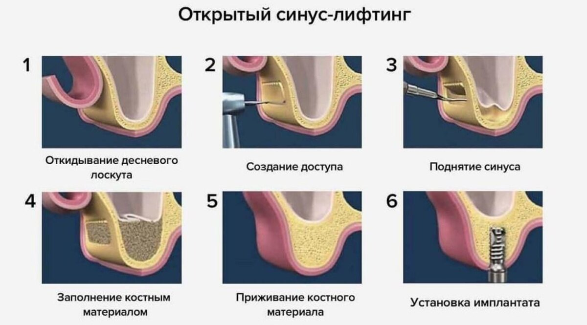 Открытый синус-лифтинг