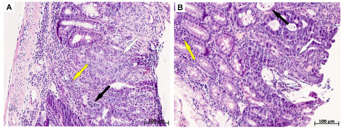 Образцы ткани толстой кишки с новообразованиями у устойчивых (А) и чувствительных (В) к гипоксии мышей. Источник: Dzhalilova et al. / PeerJ, 2025