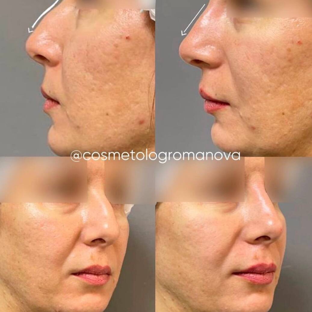 Безоперационная пластика носа в Самаре