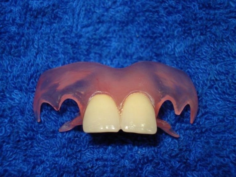 Протез-бабочка передних зубов