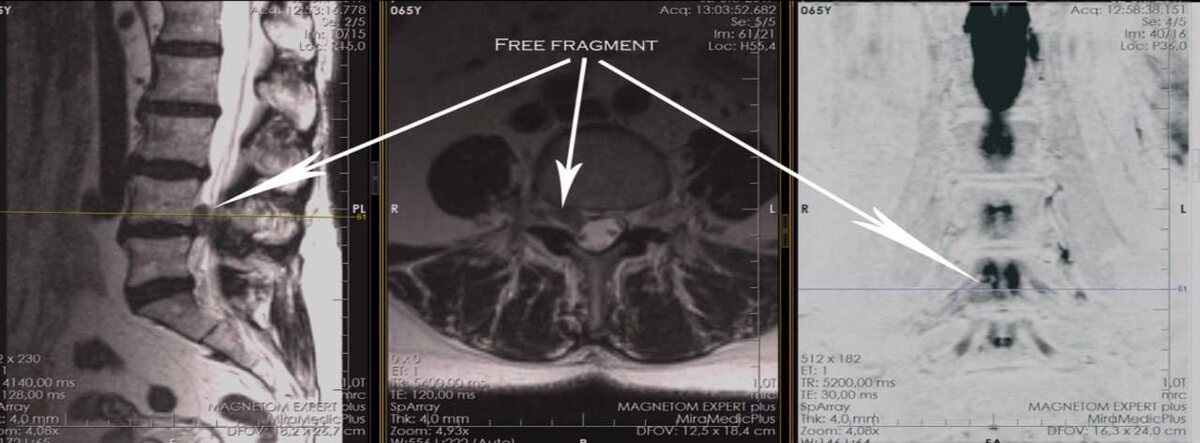 На фото изображено МРТ из практики Василия Королишина. 