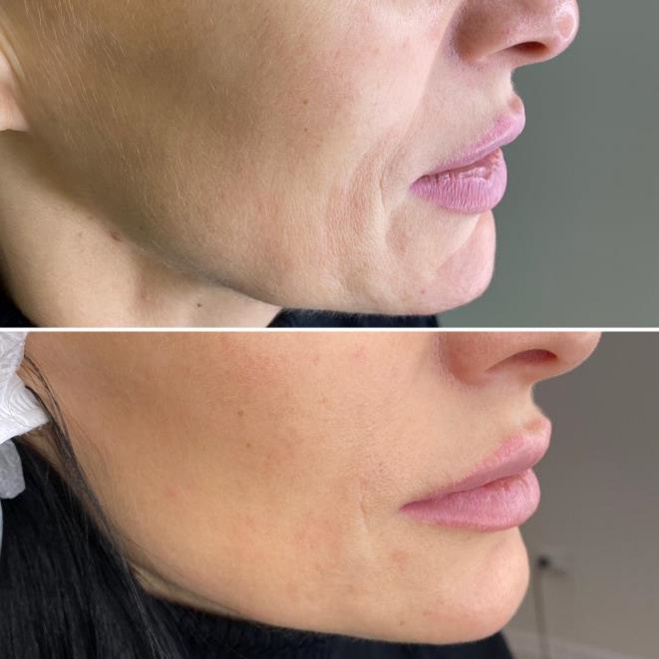 Результаты до/после процедуры микроигольчатого РФ. Клиника "Триера", г.Краснодар