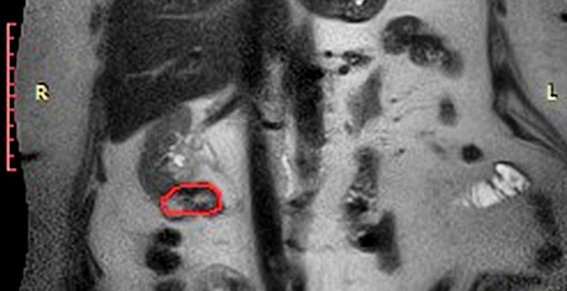    Врачи выявили рецидив опухоли в оставшейся почке на плановом контрольном обследовании