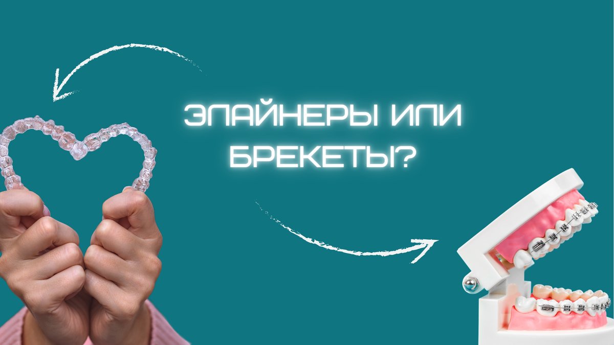 Кому подойдут элайнеры? В каких случаях помогут только брекеты?