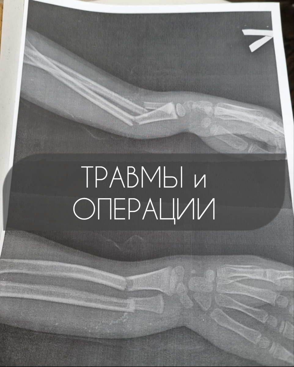 Рентген левой руки. Ребенок 5 лет.