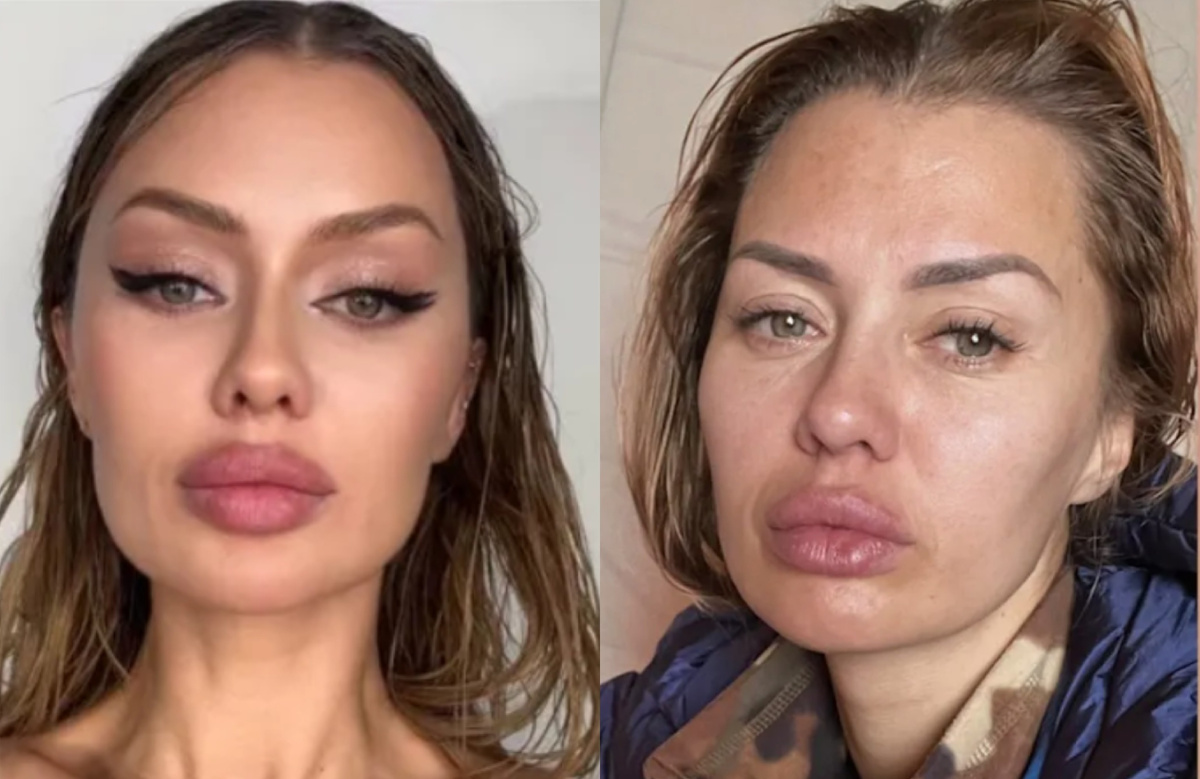 на фото Виктория Боня после очередного увеличения губ