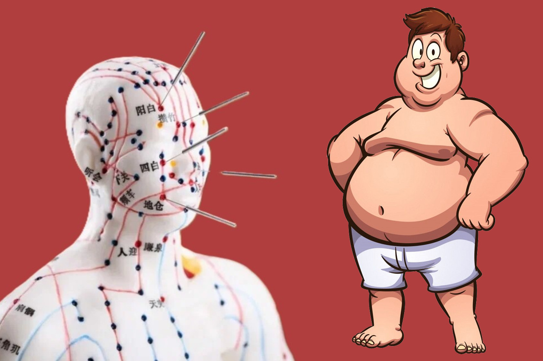 Акупунктура 