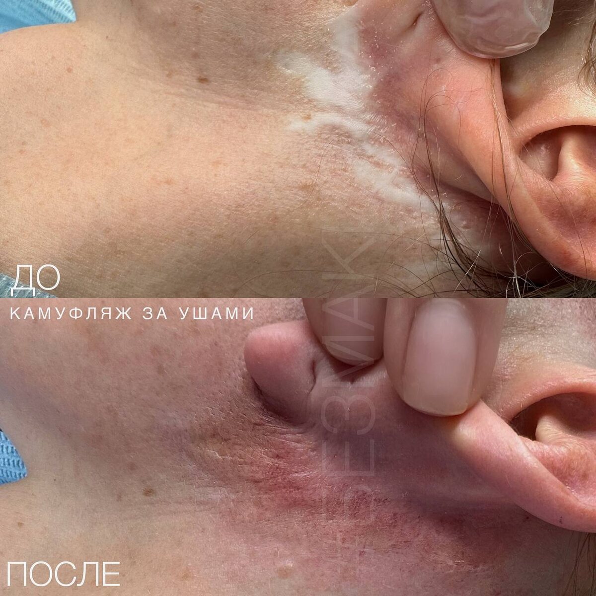 на фото показан пример до и после процедуры камуфляжа 