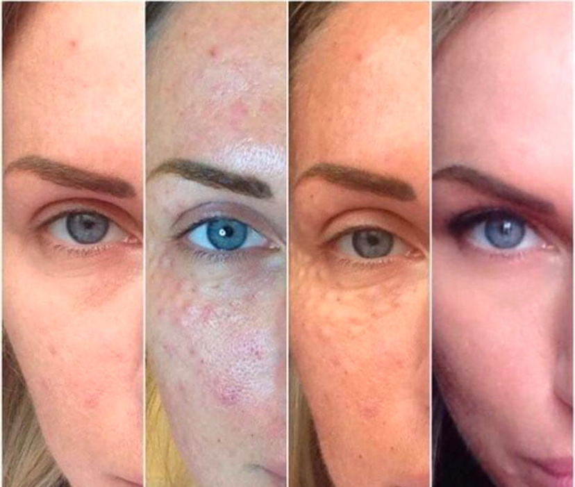 Кожа через 2 недели: увлажнение изнутри vs тонны тонального крема