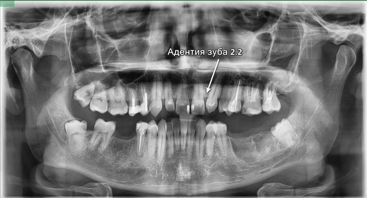 Первичная адентия — зуб 2.2 отсутствует, на его место передвинулся клык 2.3