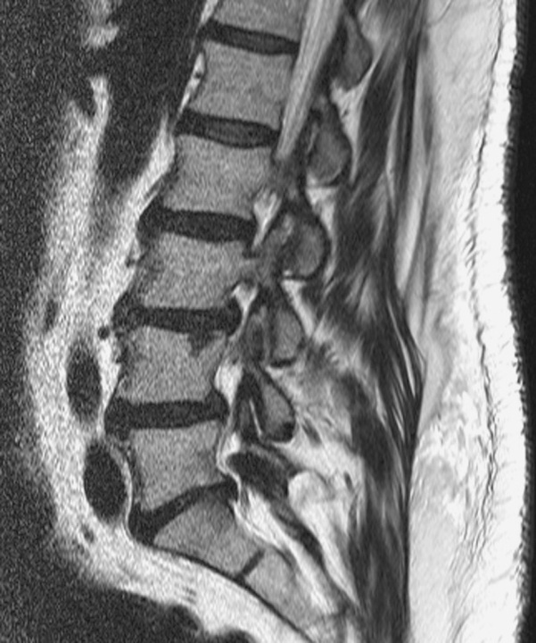 Сагиттальная МРТ, показывающая случайно обнаруженный узел Шморля на уровне L4- позвонка