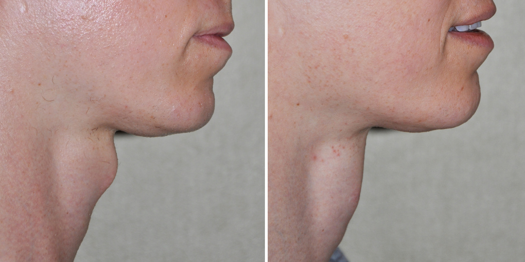 Для чего нужен кадык и почему у мужчин он виден, а у женщин – нет