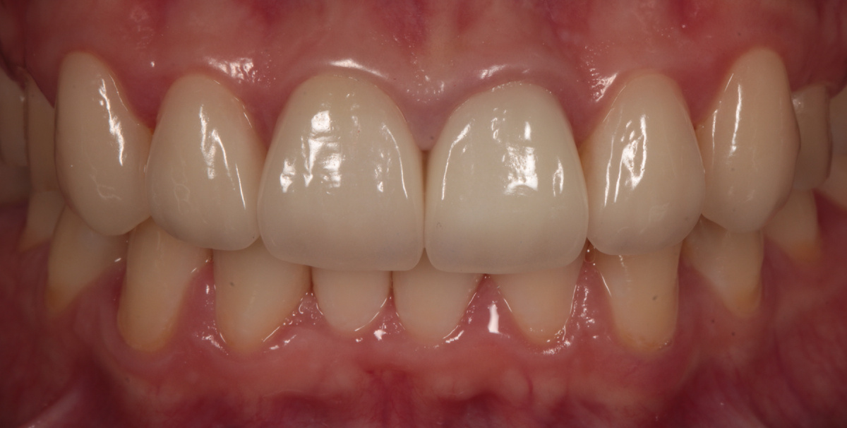 Наш пациент сразу после реставрации винирами.