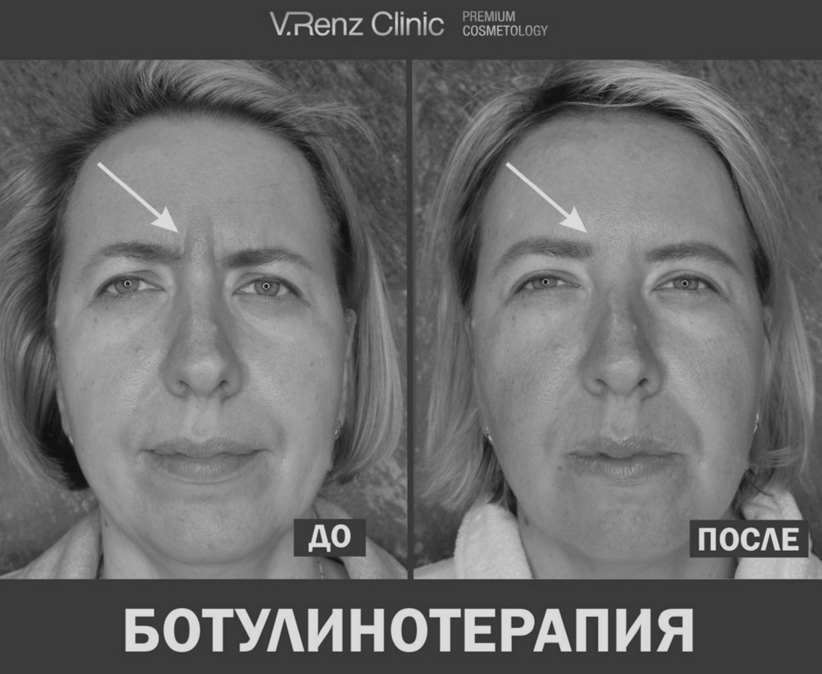 Ботулинотерапия в V.Renz Clinic 