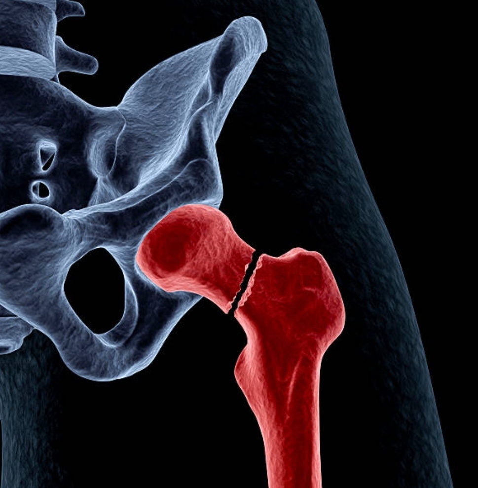 Перелом шейки бедра. Источник: www.istockphoto.com