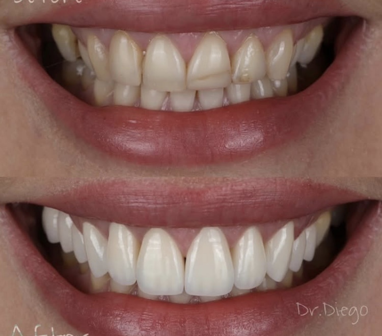 Показаний больше, но длина и цвет кошмар. Можно было ограничиться 4 резцами