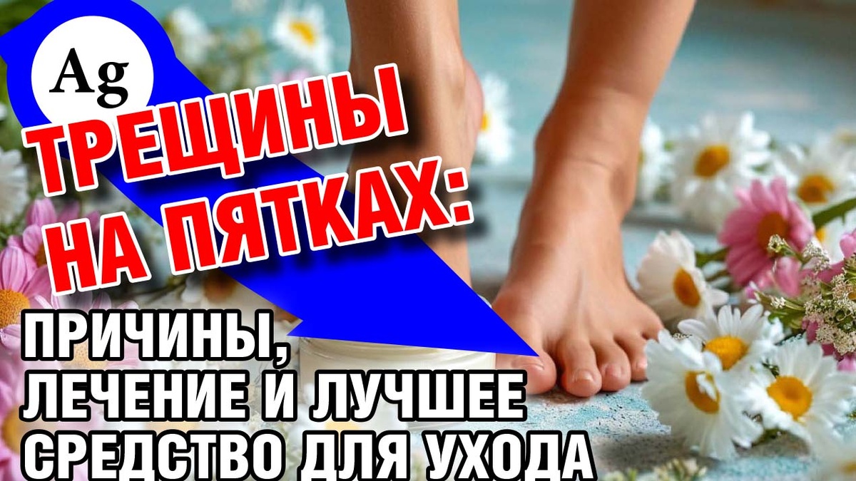 Трещины на пятках: причины, лечение и лучшее средство для ухода