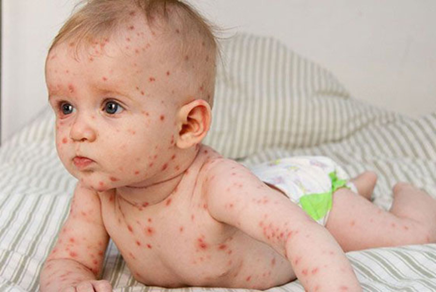 фото: https://dodoctor.by/vetryanaya-ospa-ili-chto-skryvaetsya-pod-zelyonkoj/