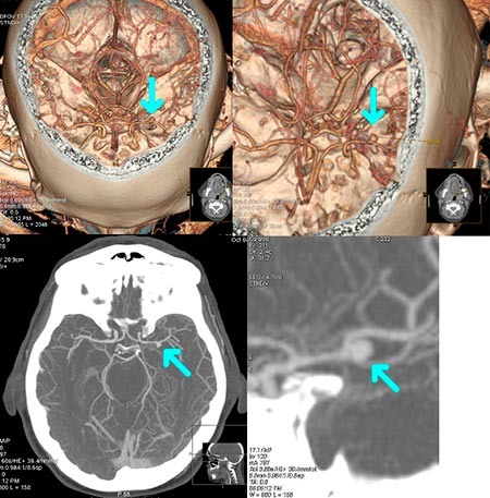 Пример того, как может выглядеть мешотчатая аневризма средней мозговой артерии на КТ-ангиографии сосудов головного мозга 