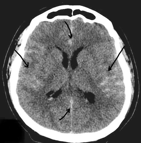 Вариант субарахноидального кровоизлияния: кровь (светлая, яркая) расположена по конвексу мозга, в корковых бороздах, межполушарной щели спереди и сзади, а также базальных цистернах мозга