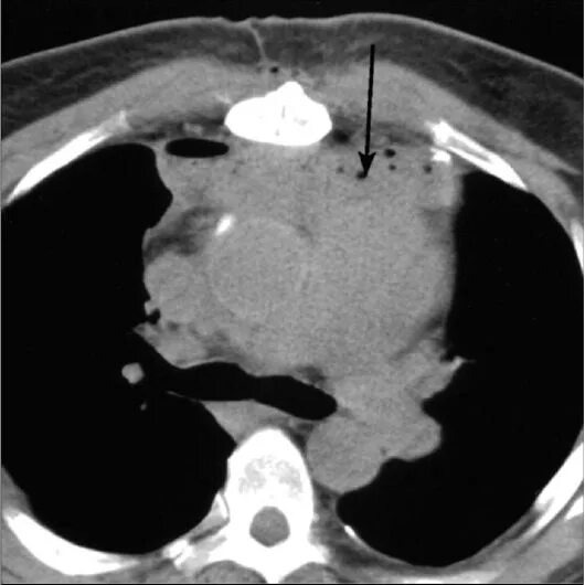 Инфильтрат определяется кпереди от аорты и лёгочного ствола на уровне бифуркации трахеи. КТ ОГК, средостенное окно, натив