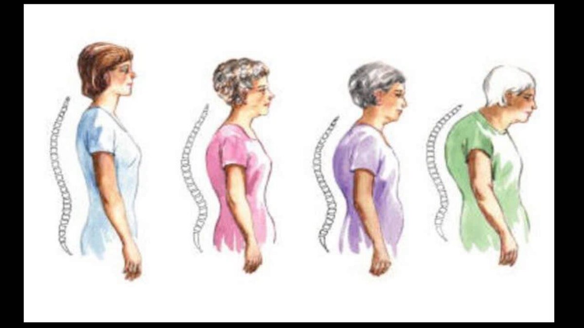 Вот так меняется осанка людей, больных остеопорозом.