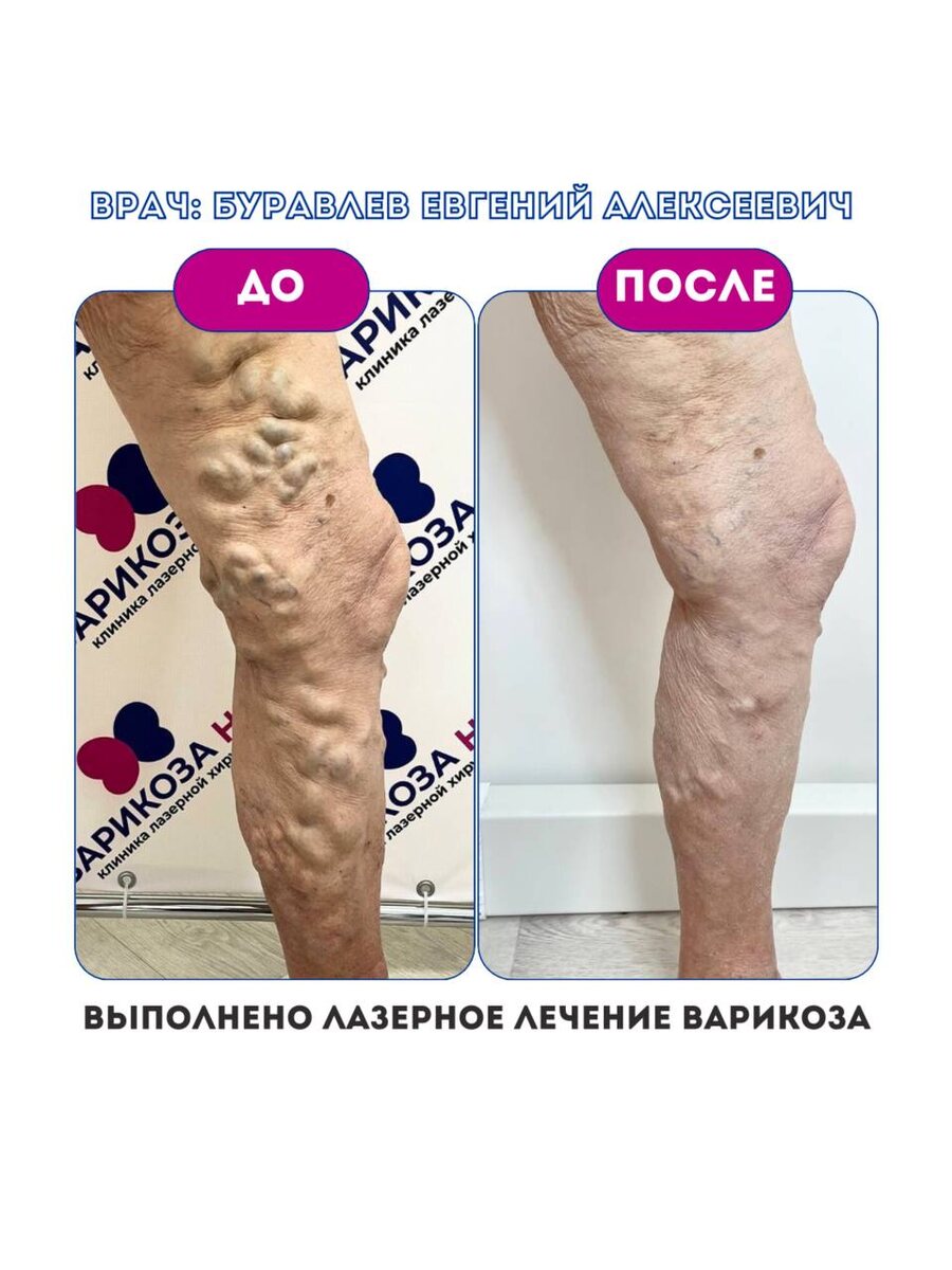 Заметили у себя такие же вздутые вены? 

Запишитесь на консультацию прямо сейчас!