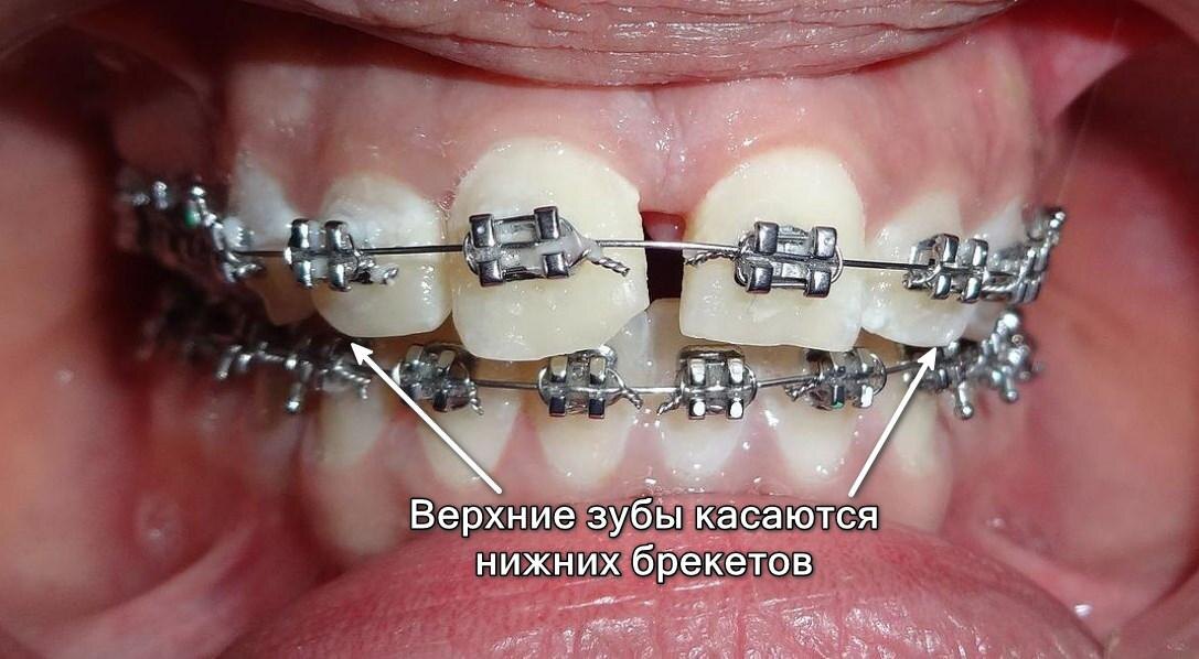Без накладок верхние зубы могут сбивать нижние брекеты