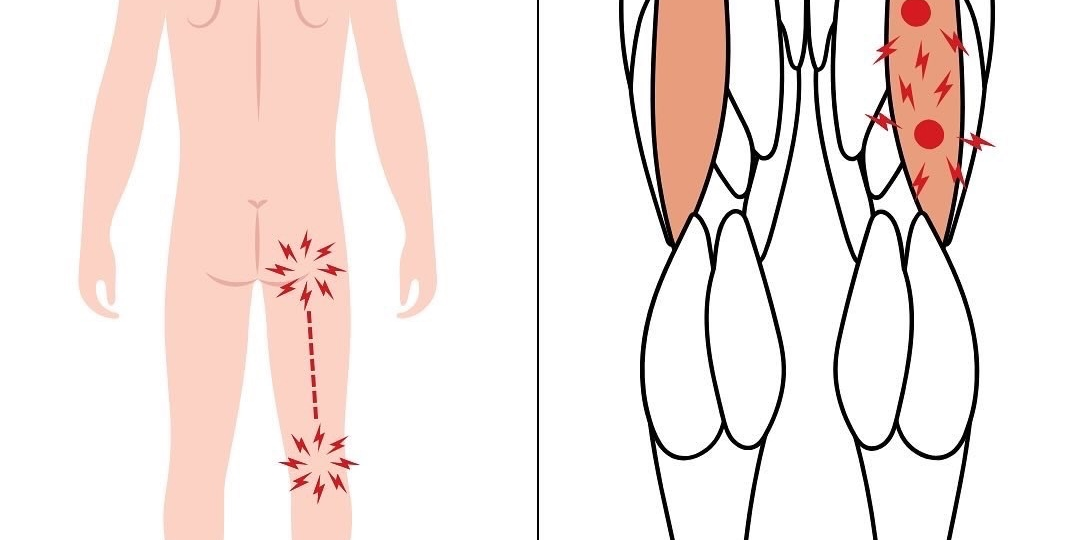 Перекос таза? Найдите триггерные точки в двуглавой мышце бедра