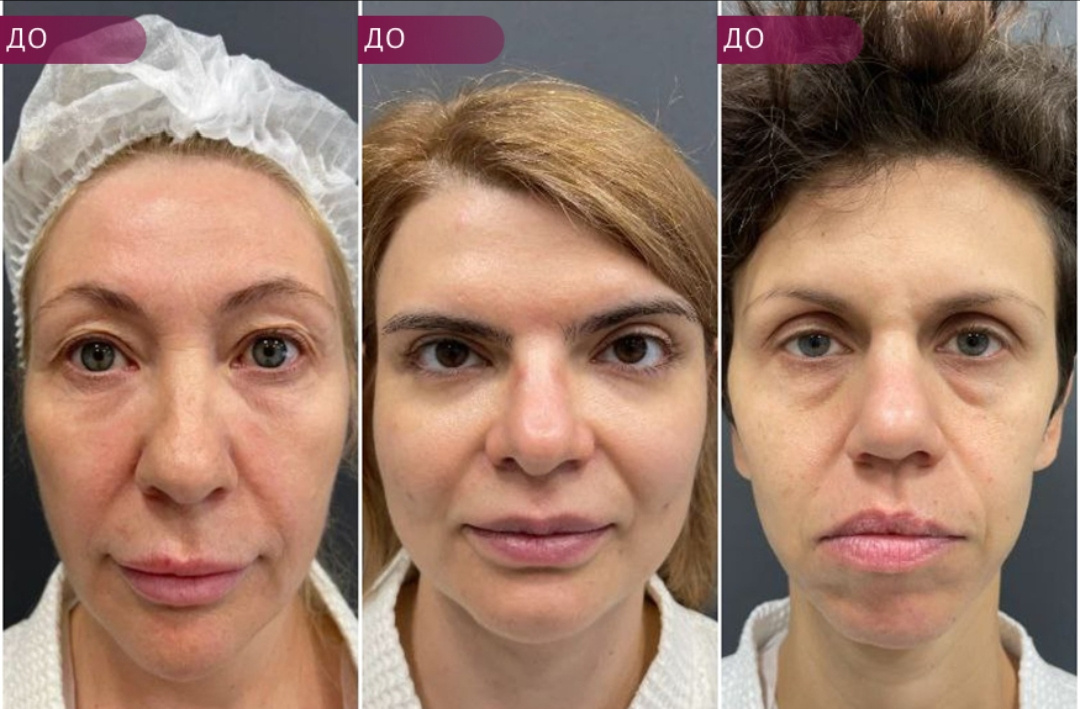 До операции 