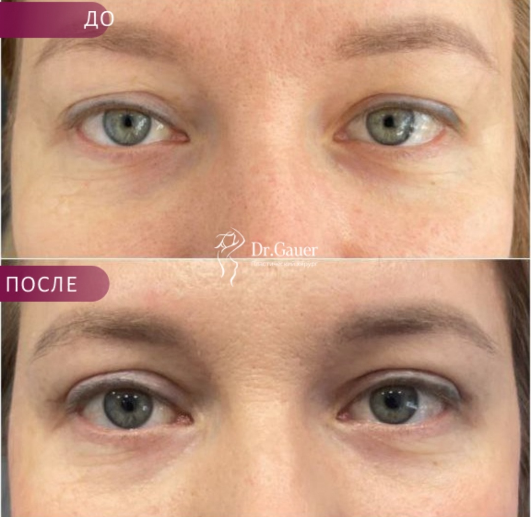 Верхняя блефаропластика 