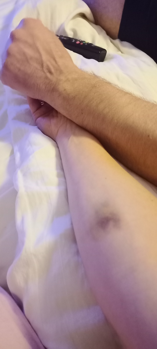 моя рука с очередным фингалом после забора крови вместе с рукой мужа