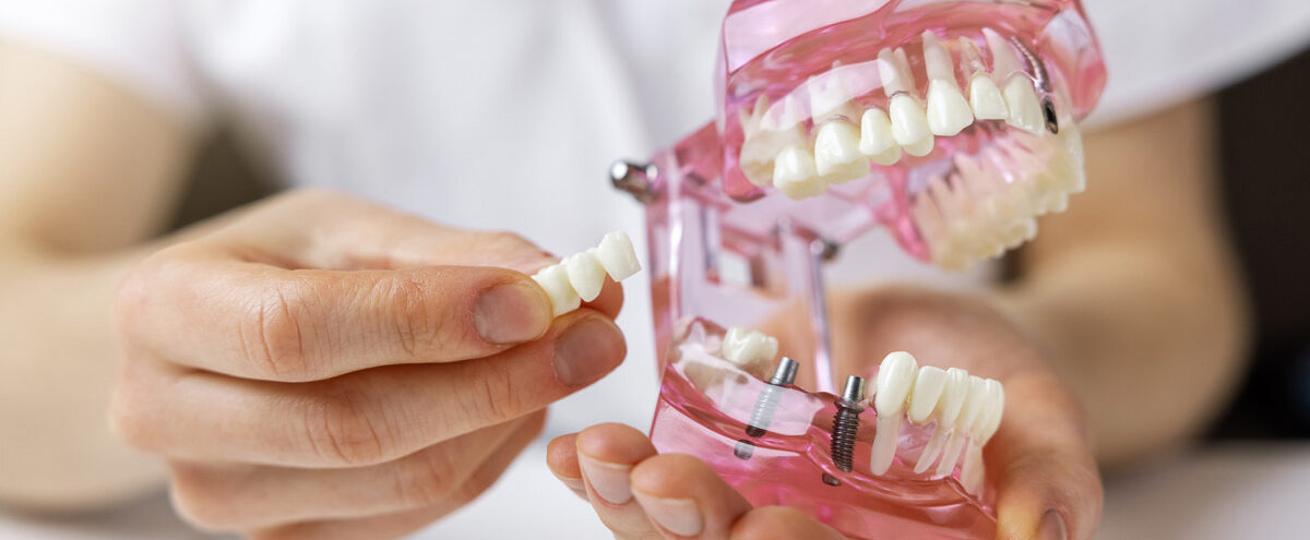 Имплантация двух зубов одновременно