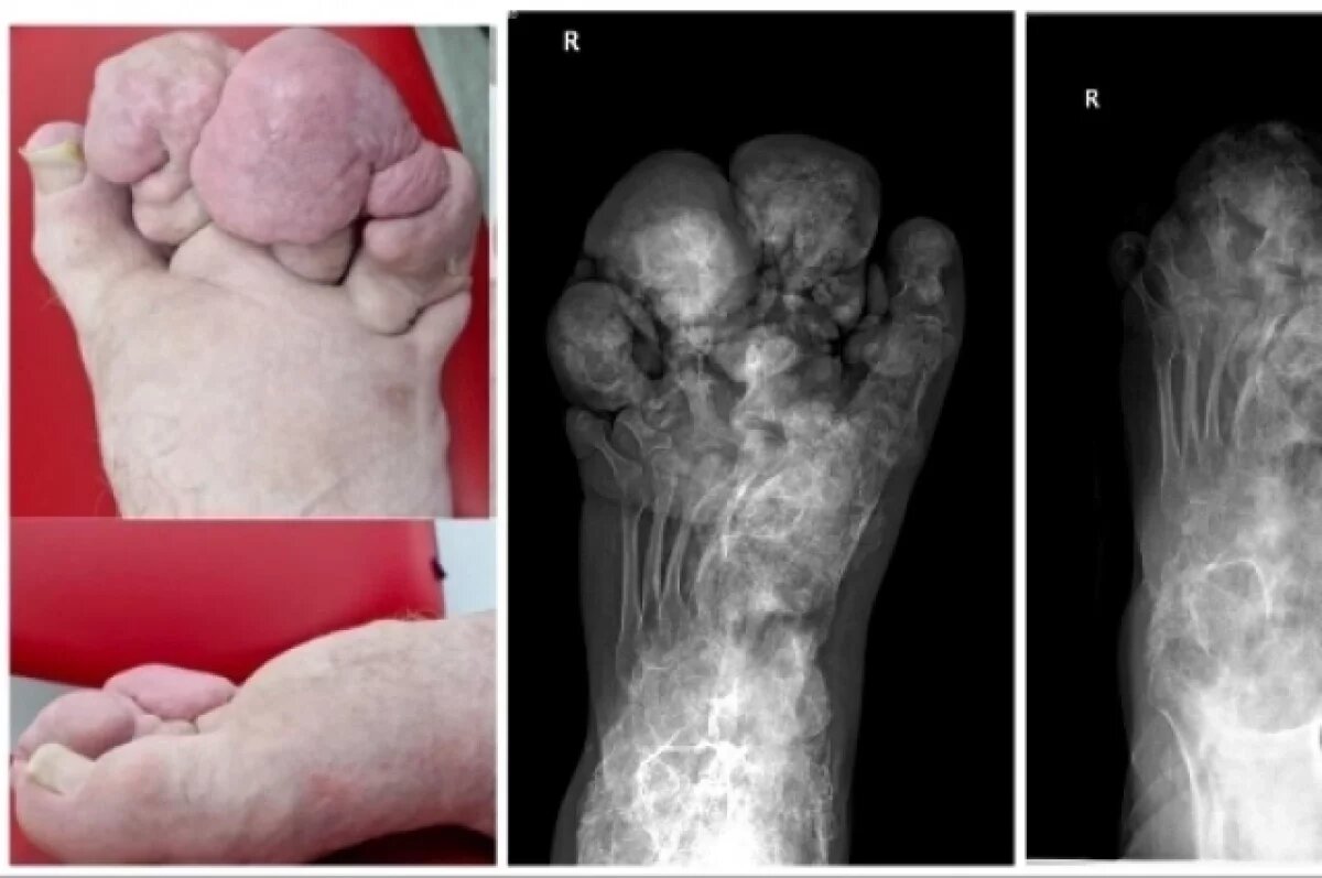    В Новосибирске хирурги спали «человека-слона» 21 века
