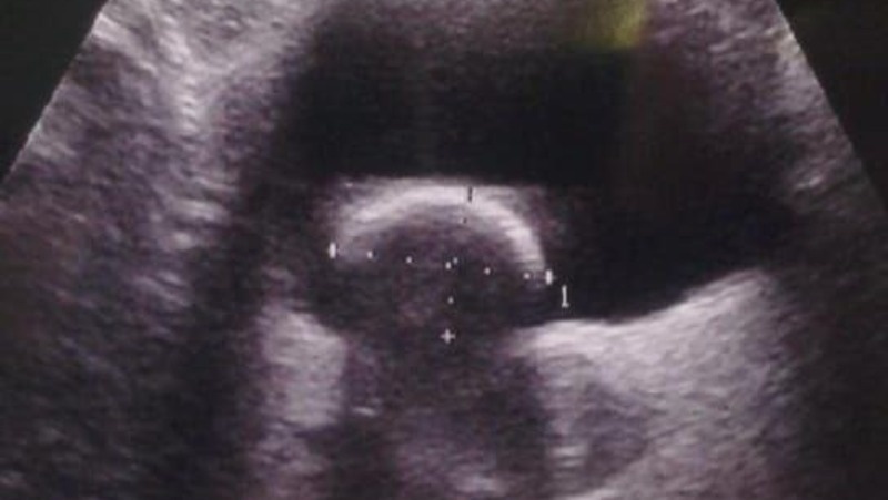    Камень вовремя обнаружили во время УЗИ-диагностики Фото: БСМП г. Ставрополя